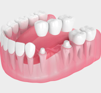 Dental Bridges