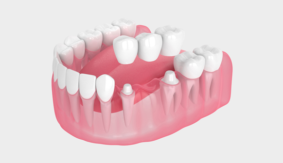 Dental Bridge in Bakersfield