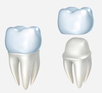 Dental Crowns