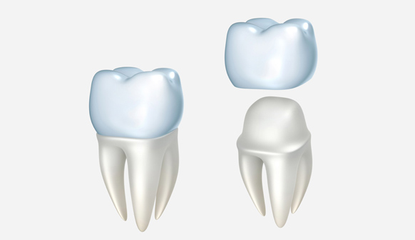 Dental Crowns in Bakersfield