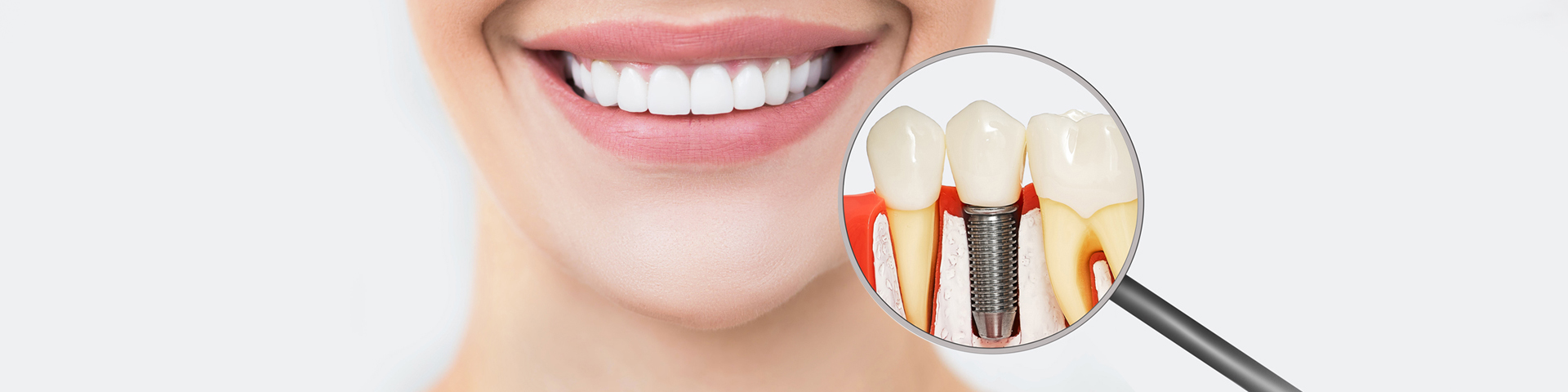 Dental Implants Restorations