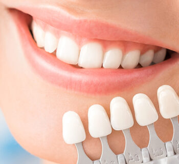 Dental Veneers
