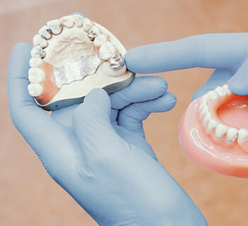 Snap on Dentures