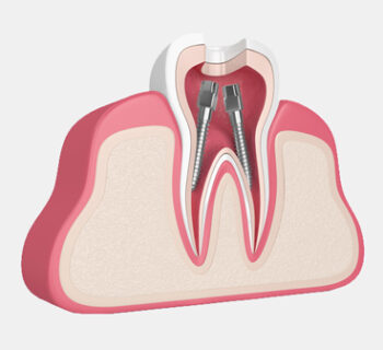 Root Canal Therapy