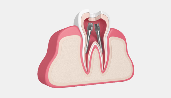 Root Canal Therapy in Bakersfield