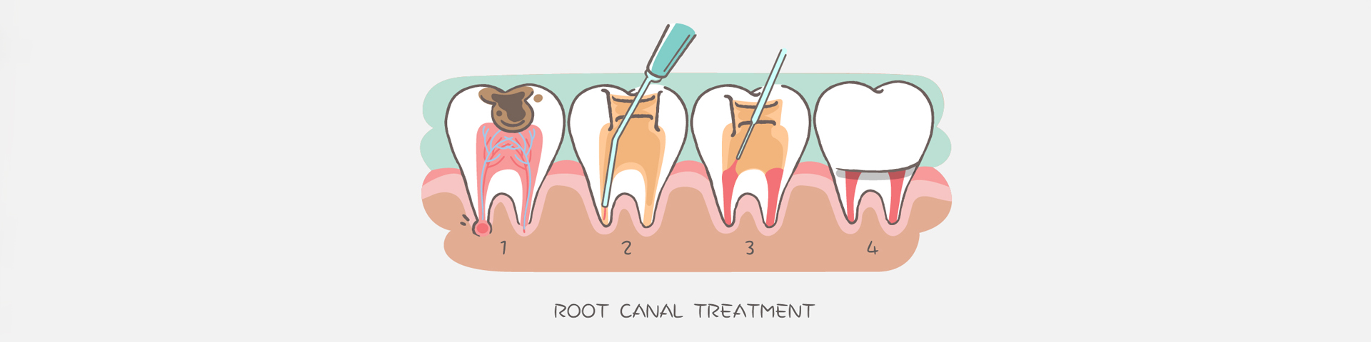 Root Canal Therapy