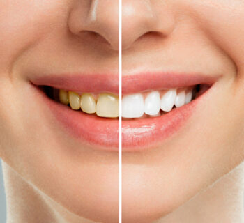 Teeth Whitening