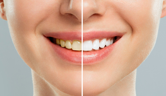 Teeth Whitening in Bakersfield