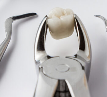 Tooth Extractions