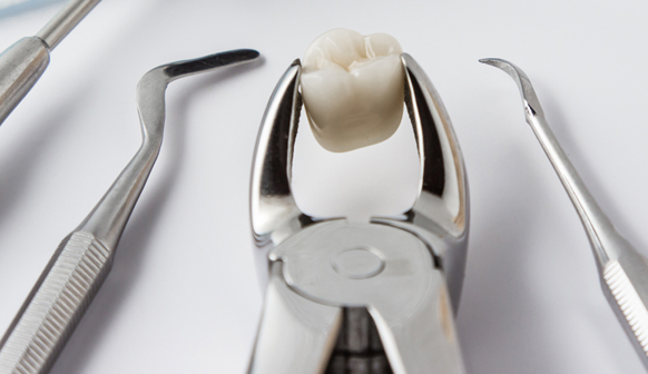 Tooth Extraction in Bakersfield, CA