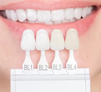 Smile Makeovers: Veneers to Boost Confidence and Appearance