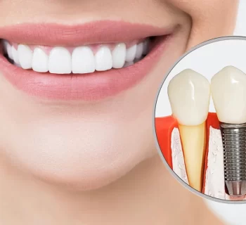 Dental Implants Bakersfield